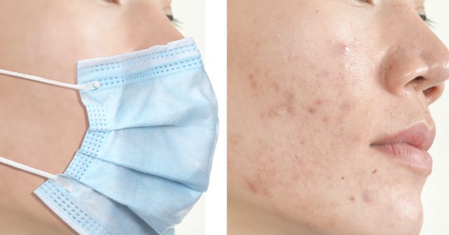 Mbajtja e maskës gjithë kohës ju ka krijuar puçrra? Dermatologët tregojnë pse ndodh kjo gjë