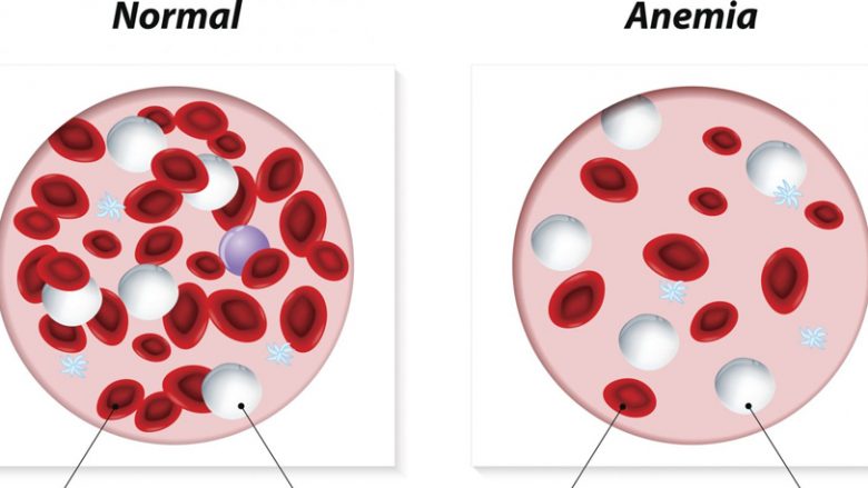 Simptomat e anemisë në mungesë të hekurit