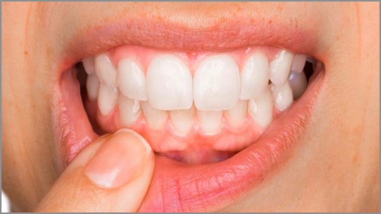 Gjakderdhja nga mishi i dhëmbëve mund të jetë një shenjë e mungesës së vitaminës C