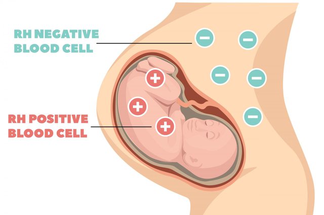 Shtatzënia dhe mospërputhja e faktorit Rhezus; Çfarë duhet të dini