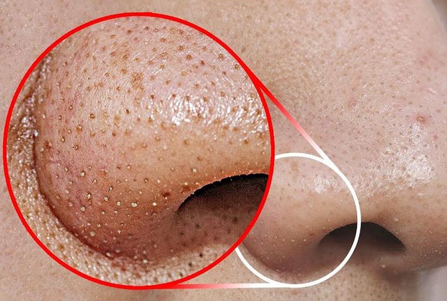 Çfarë trajtimi duhet bërë për t’i hequr pikat e zeza në hundë?