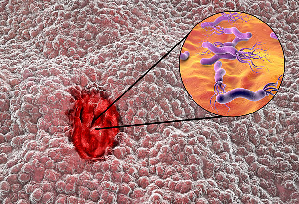 Helicobacter pylori, shkaktari kryesor i inflamacionit të stomakut