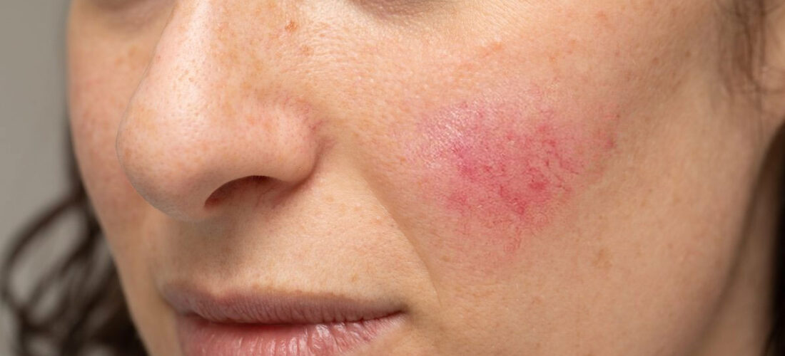 Rosacea dhe shkaqet e mundshme