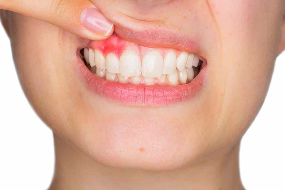 Periodontiti dhe simptomat e kësaj sëmundje