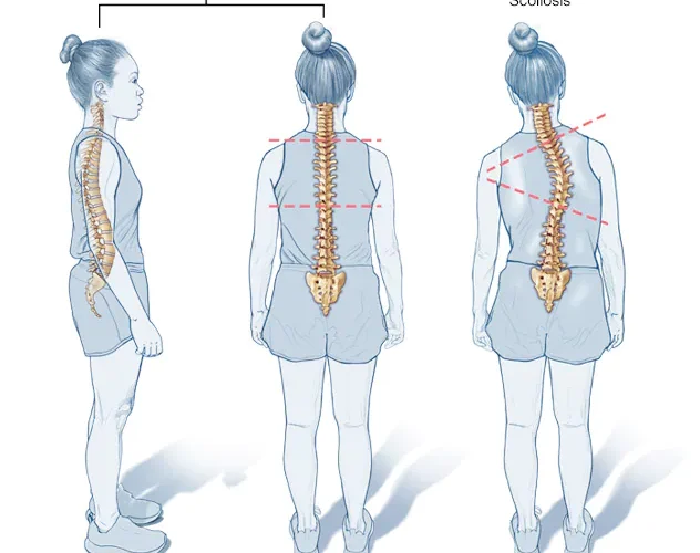 Çfarë është Skolioza?