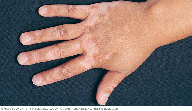 Çfarë sëmundje është Vitiligo?