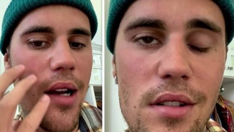 Justin Bieber zbulon se po vuan nga paraliza e fytyrës pasi u diagnostikua me sindromën Ramsay Hunt