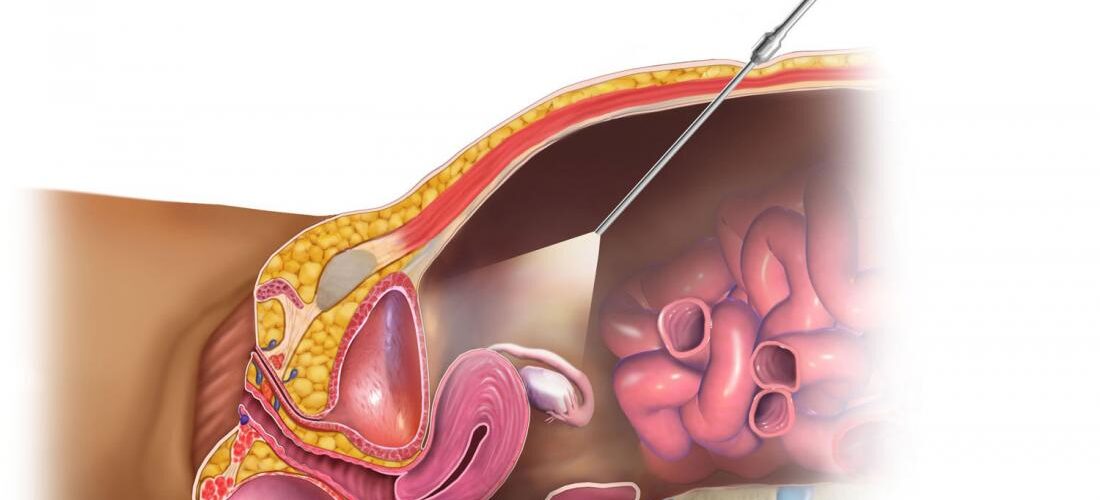 Çfarë është laparoskopia dhe kur përdoret?