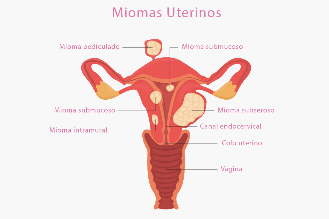 Njihuni me faktorët që ndikojnë në krijimin e miomave tek gratë