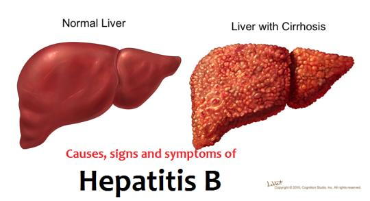 Sa mund të zgjasë infeksioni i hepatitit B ?