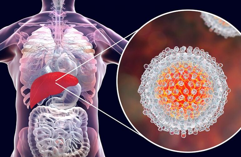 Çfarë është hepatiti toksik dhe nga çfarë shkaktohet ?
