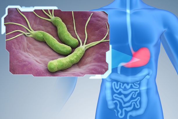 Helicobakteri Pylori dhe shkaktarët