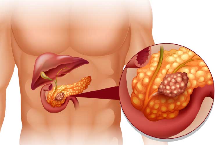 Çfarë janë tumoret neuroendokrine të pankreasit