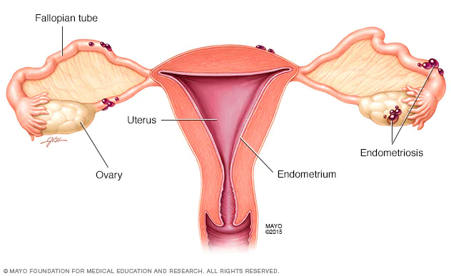 Endometrioza dhe shkaktarët