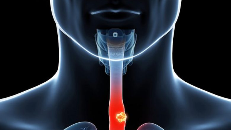 Shkencëtarët britanikë shpikin një sy artificial i cili mund të vërej kancerin e hershëm të ezofagut