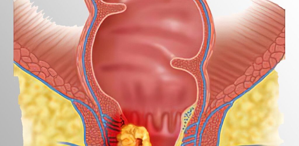 Kanceri Anal: Simptomat, Diagnostifikimi dhe Trajtimi