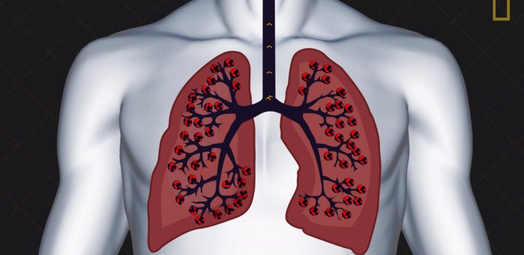 Çfarë ndodh nëse ushqimi ju hyn në mushkëri?