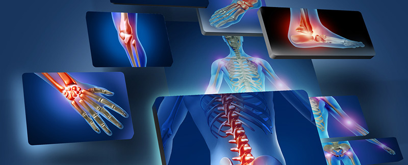 Displazia Fibroze: Simptomat, Diagnostifikimi, Trajtimi