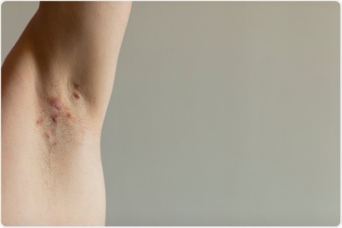 Hidradenitis Suppurativa: Simptomat, Diagnstikimi dhe Trajtimi