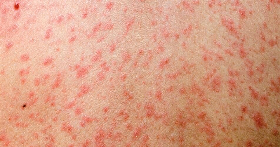 Fruthi: Simptomat, parandalimi dhe këshilla për trajtim
