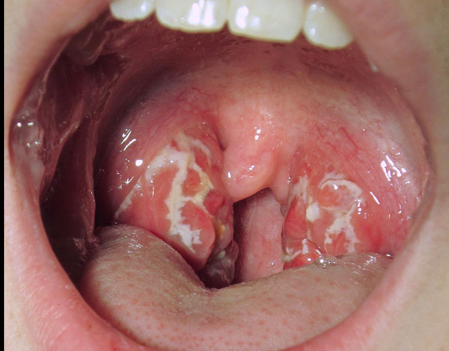 “Strep A” virusi që po merr jetë fëmijësh/ Simptomat që duhet t’i dini patjetër