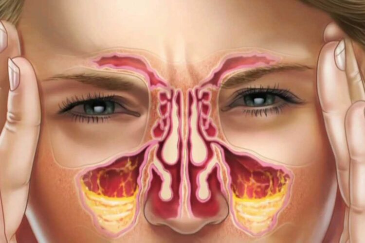 7 Gjërat që Duhet të Dini për Kujdesin Ndaj Sinuseve 