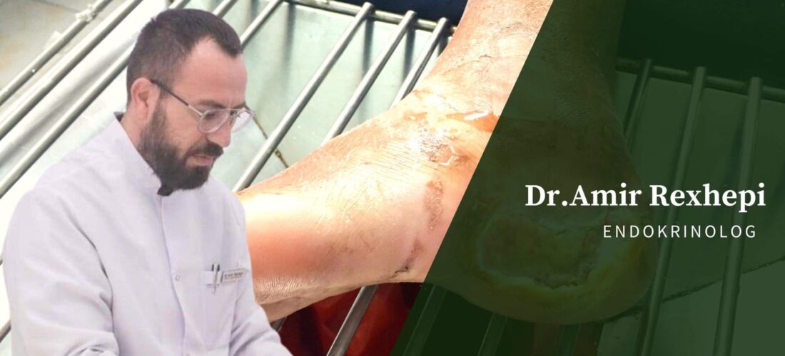 Ç’është Gangrena diabetike apo “këmba diabetike” – tregon endokrinologu, Amir Rexhepi