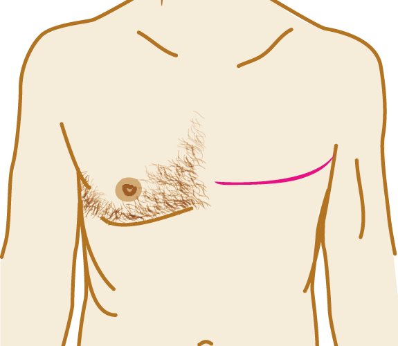 Kanceri i gjirit prek dhe meshkujt: Ja shkaqet, simptomat dhe testimi gjenetik i këtij lloji kanceri