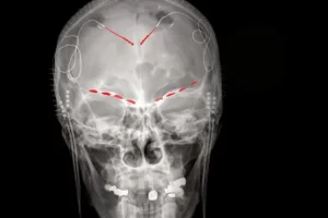 Shkencëtarët zbulojnë sinjalet e trurit për dhimbje kronike