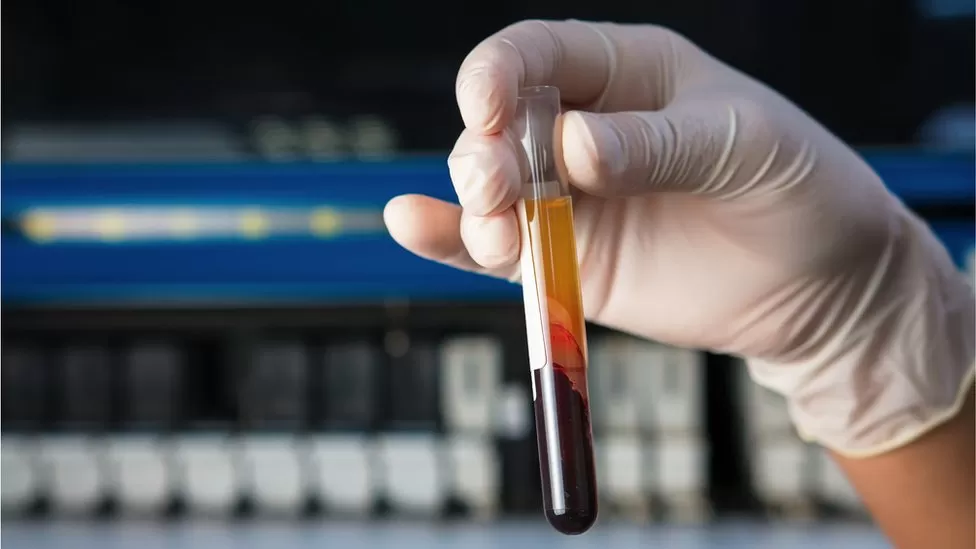 Testi i gjakut i krijuar për të zbuluar më shumë se 50 lloje të kancerit, pritet të testohet nga NHS
