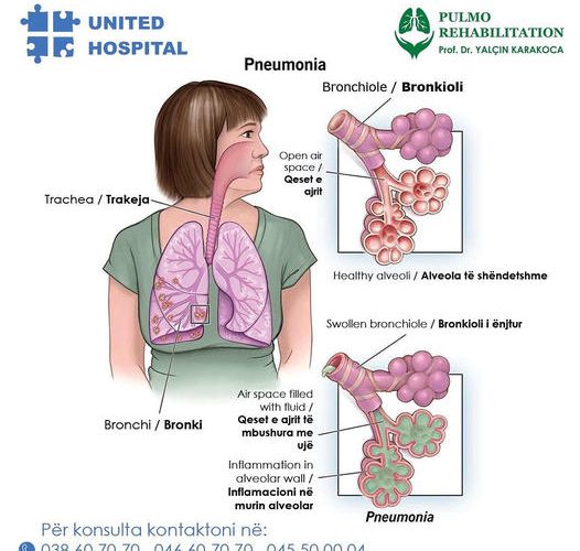 Çfarë është Pneumonia?