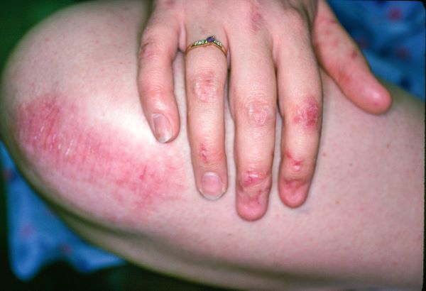 Epidermoliza Bullosa: Simptomat, Diagnostikimi dhe Trajtimi