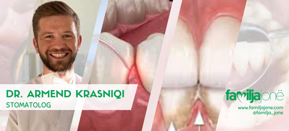 Cilat janë shkaqet e periodontitit dhe kur duhet të vizitohemi te dentisti – tregon stomatologu, Armend Krasniqi