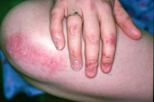 Epidermoliza Bullosa: Simptomat, Diagnostikimi dhe Trajtimi