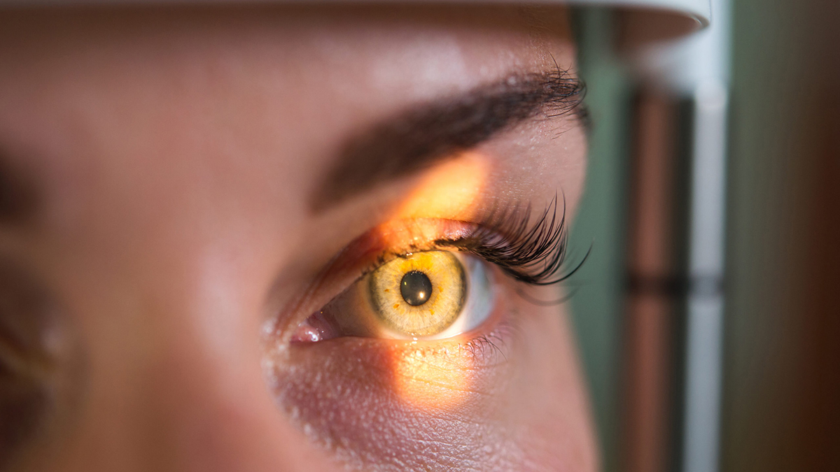 Glaukoma Arsyeja e Dytë Kryesore e Dëmtimit të Shikimit