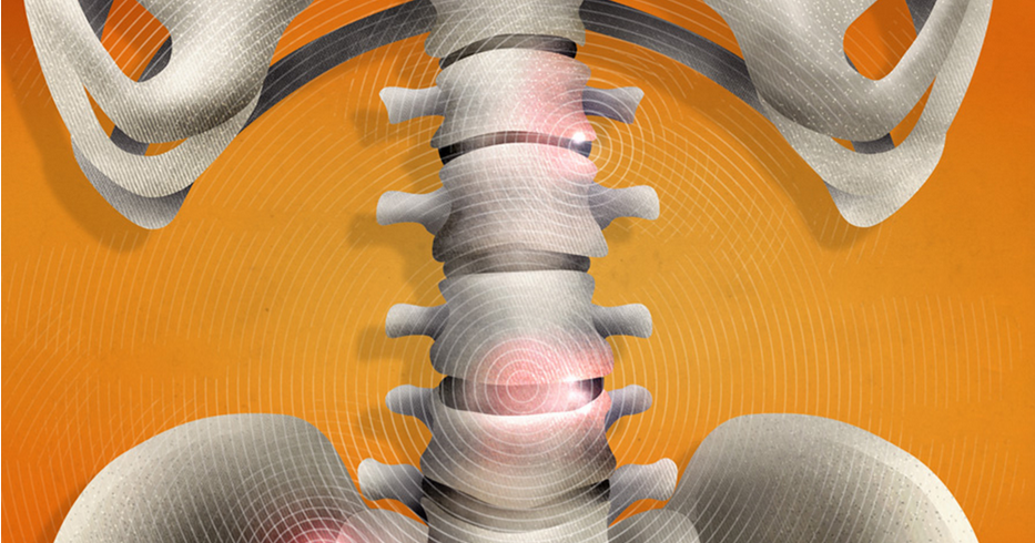 Spondiloartriti – Sëmundja që prek nyjat e shtyllës kurrizore