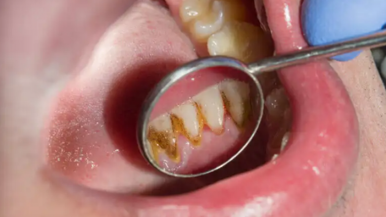 Si t’i parandaloni apo largoni gurët e zi në dhëmbë?