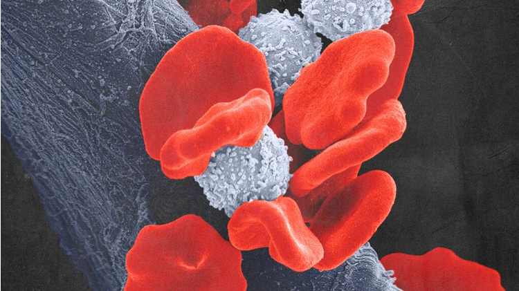 Si ndikon leukemia në trupin e njeriut?