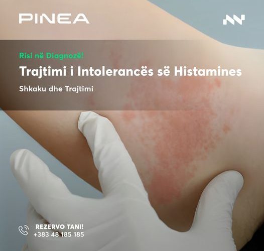 Trajtoni Intolerancën e Histamines në Pinea Medical Center