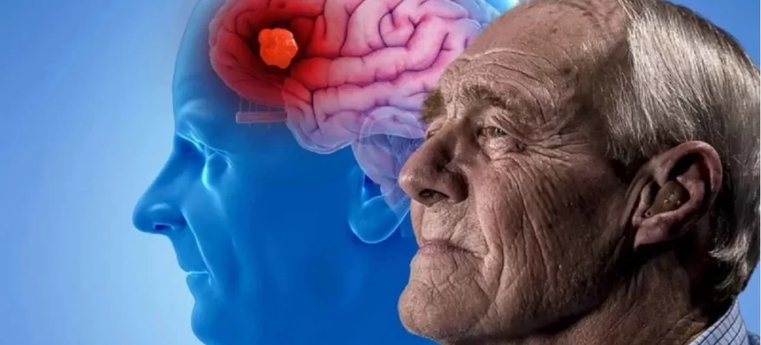 Kush janë shkaktarët e sëmundjes Alzheimer?