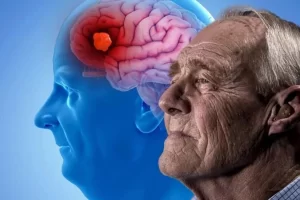 Kush janë shkaktarët e sëmundjes Alzheimer?