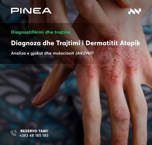 Trajtimi i dermatiti atopik për herë të parë në vend vetëm në Pinea Medical Center