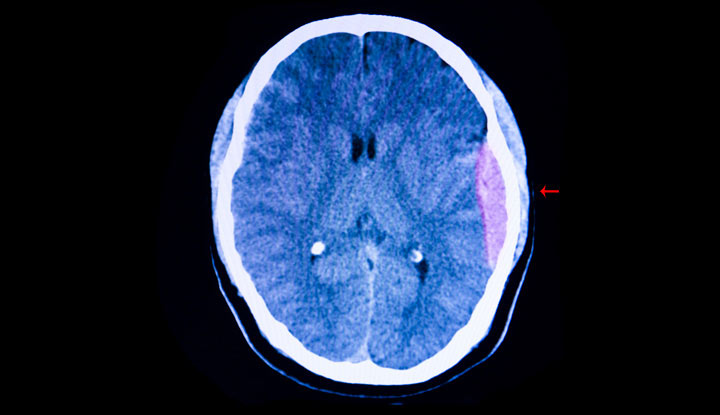 Çka është Hematoma Epidurale?