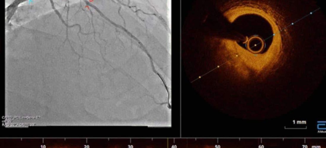 Sistemi Imazherik Intravaskular OCT tani edhe në klinikën e kardiologjisë në Kosovë