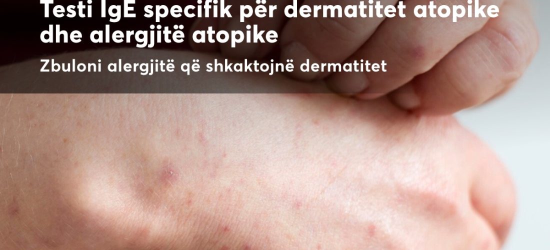 Testi IgE Specifik për dermatitet atopike: Diagnostikim i Avancuar në Pinea Medical Center