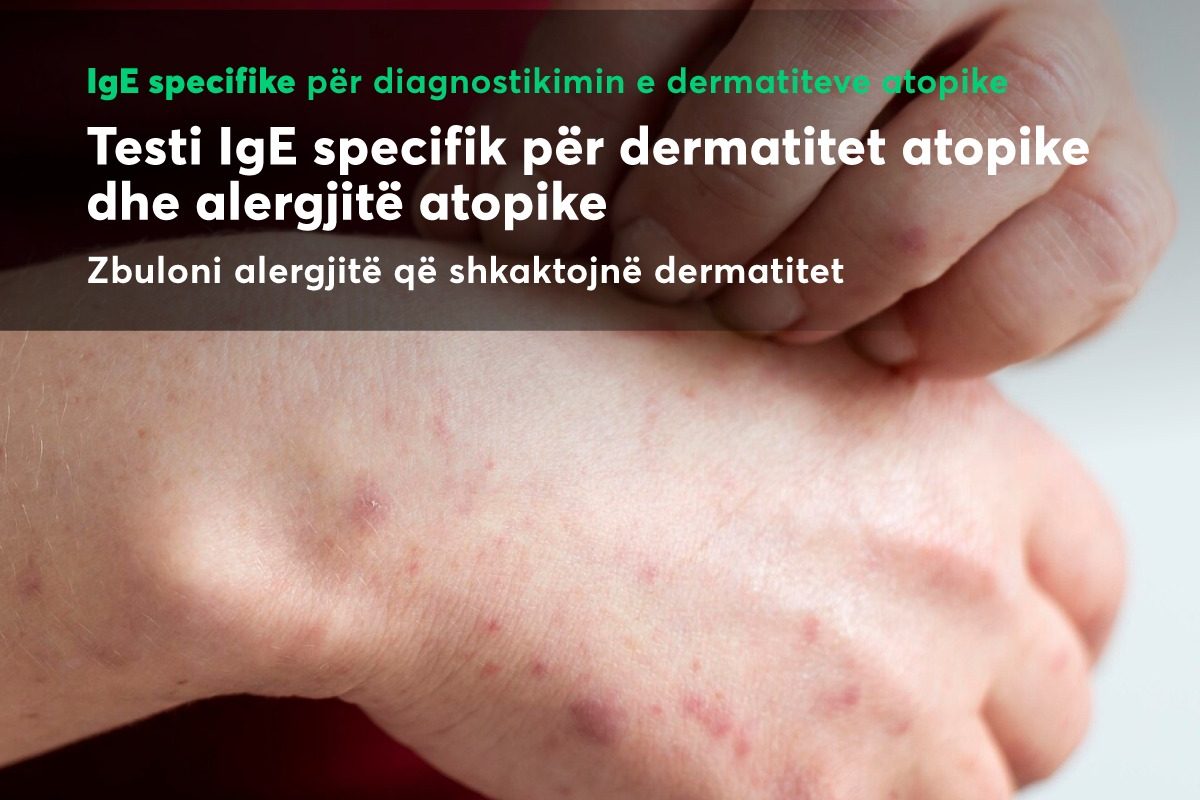 Testi IgE Specifik për dermatitet atopike: Diagnostikim i Avancuar në Pinea Medical Center