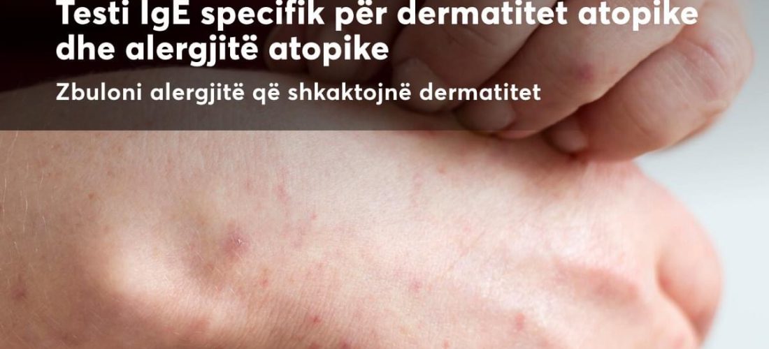 Testi IgE specifik për dermatitet atopike – Pinea Medical Center