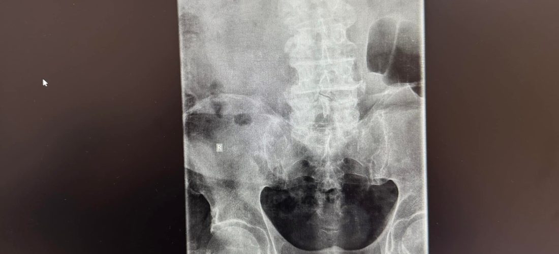 Sëmundja Forestier – Hiperostoza difuze idiopatike skeletore – Dr. Fidan Berisha, reumatolog
