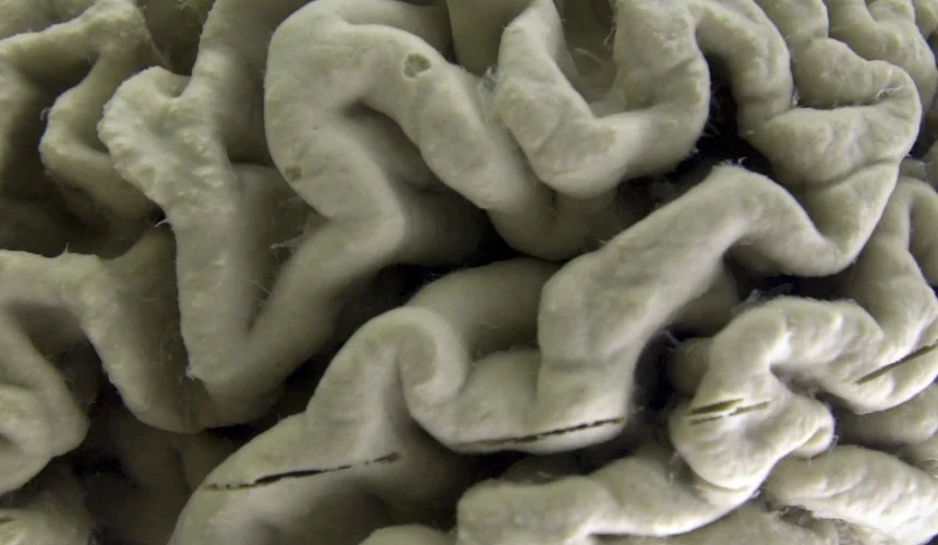 Rreziku për Alzheimer rritet kur mungesa e gjumit të thellë shkakton dëmtime në tru
