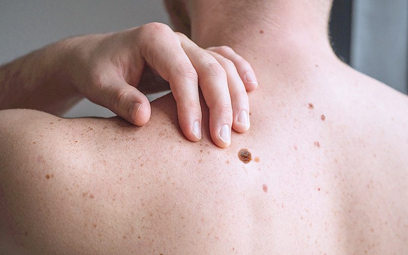 Shenjat e hershme të melanomës: Çfarë duhet të dini?